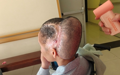 Đột quỵ sau hút mỡ làm đẹp