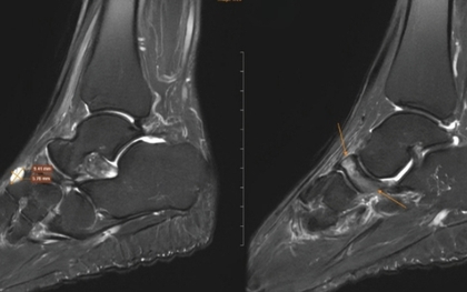 Nữ giáo viên đi khám đau cổ chân, bất ngờ phát hiện bị bệnh 'triệu người có một'