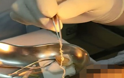 "Sốc nặng" với chàng trai 24 tuổi nhưng 13 năm bị sinh vật sống "gặm nhấm" não, gây tàn tật: Gắp ra ngoài còn ngoe nguẩy