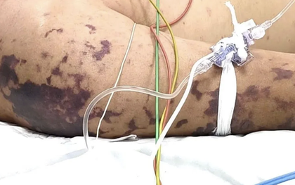 4 ca tử vong do não mô cầu, Bộ Y tế cảnh báo nguy cơ