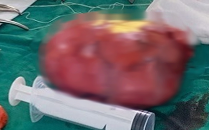 Đau bụng tưởng nhẹ, người phụ nữ sốc nặng khi bác sĩ lấy ra thứ “đáng sợ” trong bụng