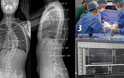 Cô gái soi gương thấy lưng có dấu hiệu lạ, không ngờ cột sống đã cong 53 độ
