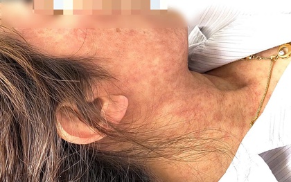 Người phụ nữ 42 tuổi bị nhiễm trùng, xuất huyết do biến chứng bệnh sởi, BS Bệnh viện Bệnh Nhiệt đới Trung ương nhắc làm ngay 1 việc để phòng tránh