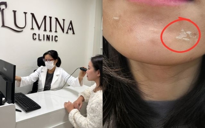 Peel da không phải “cứ làm là đẹp”: Chuyên gia cảnh báo 4 sai lầm khiến da càng ngày càng tệ