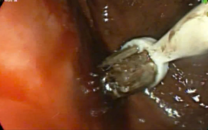 Nam thanh niên 29 tuổi đau bụng, bác sĩ lấy ra thứ "đáng sợ" trong cơ thể