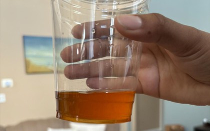 Ngày càng có nhiều người tử vong vì ung thư tuyến tụy, bác sĩ nhắc: Đừng xem nhẹ 3 thứ khi đi vệ sinh!