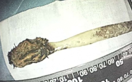 Đau bụng đi khám, người đàn ông "sốc" phát hiện bàn chải nằm trong bụng 52 năm