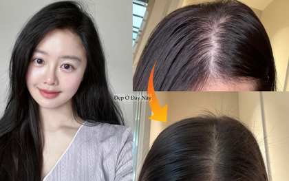 Tóc rụng đến nỗi lộ cả mảng da đầu, tôi quyết định theo 5 quy tắc chăm sóc sau để tóc đen dày trở lại