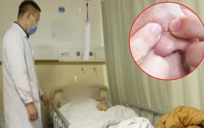 Nặn mụn trên mặt, người đàn ông 51 tuổi phát triển khối u ác tính