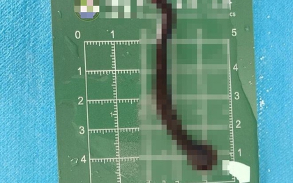 Bé trai 8 tuổi ho ra máu suốt 10 ngày, bác sĩ gắp được "thủ phạm" hút máu dài 8cm đang ngo ngoe bò trườn