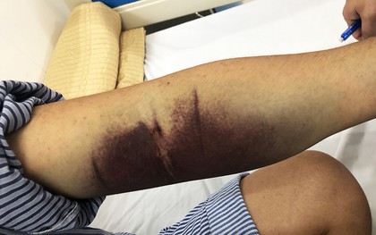 Gần 32.000 ca mắc, 4 ca tử vong: Bệnh viện Bạch Mai phát cảnh báo về 1 căn bệnh đang tăng nhanh, có thể suy đa tạng chỉ trong vài ngày