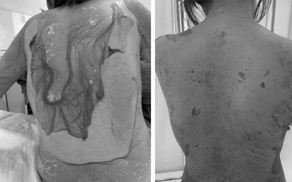 Hải Phòng: 1 phụ nữ 35 tuổi bị tróc da như "cua lột" vì thói quen dùng thuốc cực kỳ phổ biến