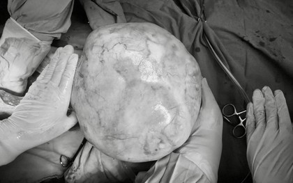 Hy hữu: Bé gái 14 tuổi mang khối u buồng trứng hơn 4kg, bác sĩ cảnh báo những dấu hiệu sớm nhưng hay bị bỏ qua