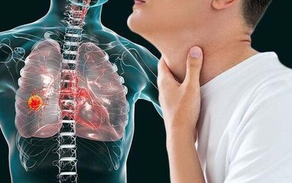 Không phải ho dai dẳng: 5 DẤU HIỆU cảnh báo ung thư phổi nhiều người vẫn lầm tưởng là bình thường