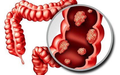 6 dấu hiệu cảnh báo đỏ của "căn bệnh ung thư đáng sợ": Có 1 cũng cần đi khám ngay!