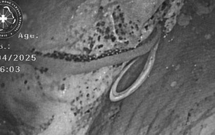 Đi siêu âm, người đàn ông chết lặng khi phát hiện sinh vật “đáng sợ” trong bụng