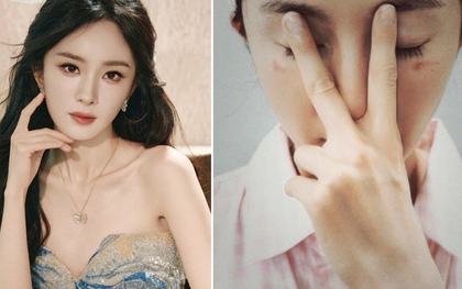 Dương Mịch nghi bị bỏng do mặt nạ mắt hơi nước: Chuyên gia khuyến cáo một điều khi dùng