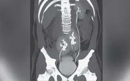 Đi khám nhiễm trùng tiết niệu, người đàn ông 31 tuổi phát hiện có 3 quả thận