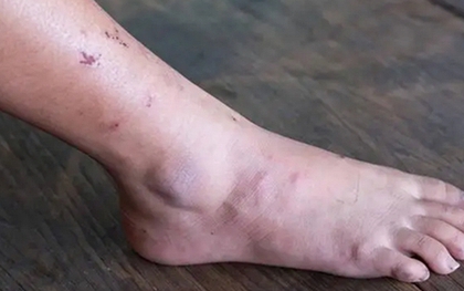 Khi ung thư mới bắt đầu hình thành, người ta thường cảm thấy 3 điều không ổn, nhưng ít ai chú ý đến