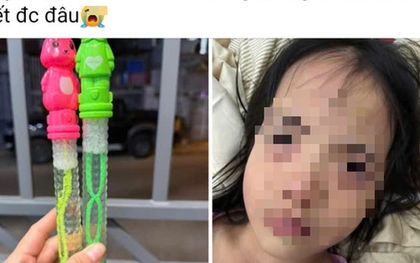 Bé gái 5 tuổi tổn thương mắt sau khi thổi bong bóng xà phòng