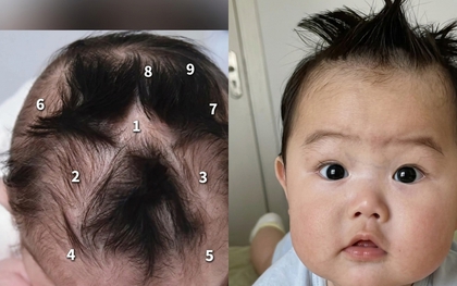 Em bé gây chú ý vì có tới 9 xoáy tóc trên đầu: Liệu có điều gì đặc biệt liên quan đến não bộ của bé?