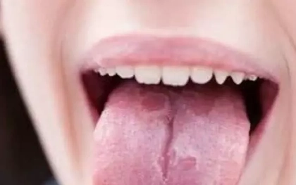 Nấm miệng họng do Candida: Cảnh báo từ những mảng trắng bất thường
