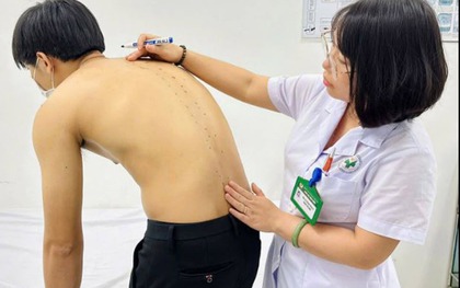 Tưởng đau lưng do tập gym, chàng trai 20 tuổi mắc viêm cột sống dính khớp