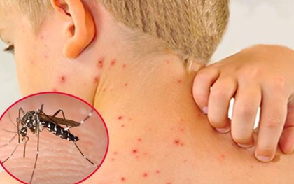 Dịch sốt xuất huyết tăng cao, chuyên gia cảnh báo biến chứng nặng của bệnh
