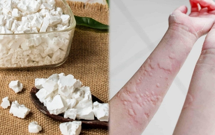 Trong nhà có bột sắn dây: Pha ngay theo cách này để cơ thể THẢI ĐỘC, đánh bay mẩn ngứa, mề đay mùa nắng nóng