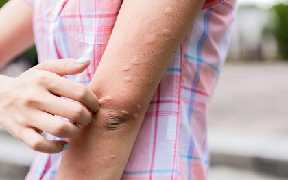 Các phản ứng dị ứng và miễn dịch sau tiêm vắc-xin: Bác sĩ Bệnh viện Bạch Mai khuyên "hiểu đúng"