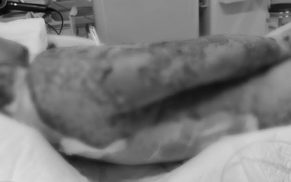 Người đàn ông 35 tuổi bị tróc da như "cua lột" toàn thân, suýt mất mạng vì kiểu dùng thuốc cực kỳ phổ biến