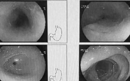 Người phụ nữ 42 tuổi loét thực quản vì thói quen ăn lẩu "vạn người mê"