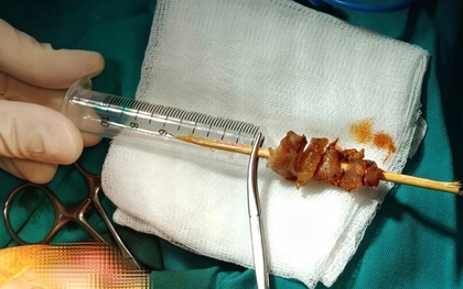 Cuộc hội chẩn xuyên đêm cứu bé gái gặp tai nạn hi hữu do que xiên thịt