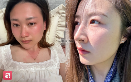 "Cứu tinh" mùa hè: 4 sản phẩm làm dịu da bỏng rát, đỏ ửng sau khi đi nắng về