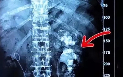 Cô gái trẻ nhập viện, bác sĩ phát hiện hai bên thận chi chít sỏi vì món đồ uống yêu thích