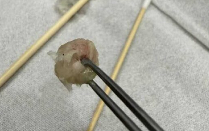 Bé gái 6 tuổi nhập viện khẩn cấp, bố mẹ "sốc" khi bác sĩ lấy ra thứ "đáng sợ" từ mũi con