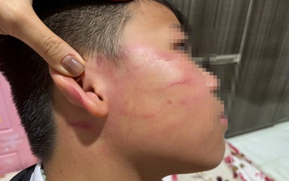 Vụ giáo viên nước ngoài tát học sinh: Gia đình nói bé trai bị thủng màng nhĩ