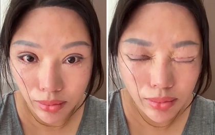 Phẫu thuật mí mắt hỏng, nạn nhân còn bị kiện ngược