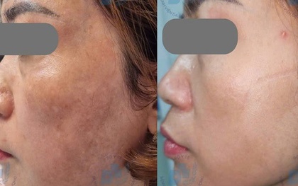 Nám da có nên điều trị bằng laser?