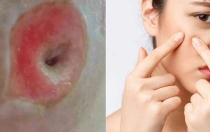 Người phụ nữ 40 tuổi chết lặng khi thấy mặt như "tổ ong" vì sai lầm ai cũng dễ mắc