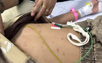 Bé trai mắc não mô cầu thoát chết nhờ phát hiện nốt ‘tử ban’ trên da