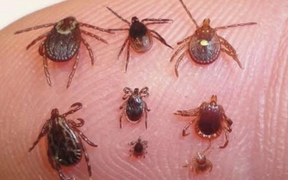 Gắp ra 17 con ve trên cơ thể người đàn ông bị sốt cao kéo dài
