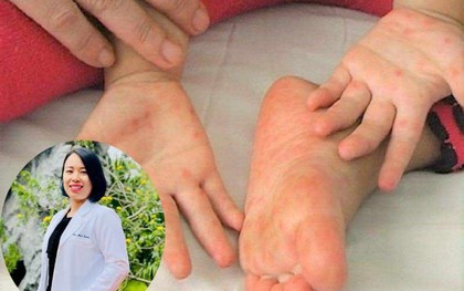 BS khoa Nhi cảnh báo dấu hiệu virus tấn công tế bào thần kinh, cha mẹ không được bỏ qua