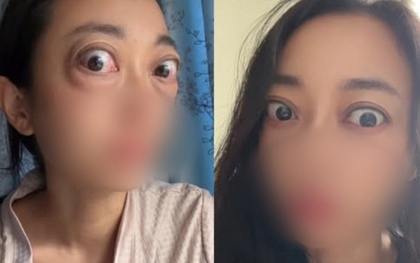 Nhìn đôi mắt "ếch" của người phụ nữ, ai cũng thương, câu chuyện phía sau là bài học cảnh tỉnh nhiều người trẻ