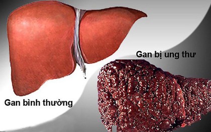 Người thuộc nhóm nguy cơ cao mắc ung thư gan cần làm gì?