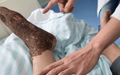 Bị rắn độc cắn khi đang cấy lúa, người đàn ông làm 1 việc khiến bác sĩ khen ngợi