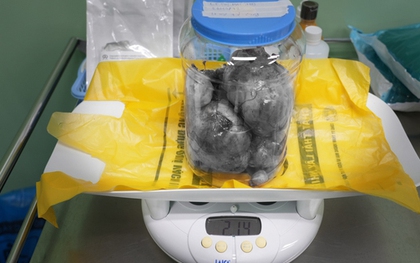 Ca mổ lấy thai đặc biệt: Đón bé 3,3kg chào đời và bóc tách thành công 9 khối u xơ tử cung