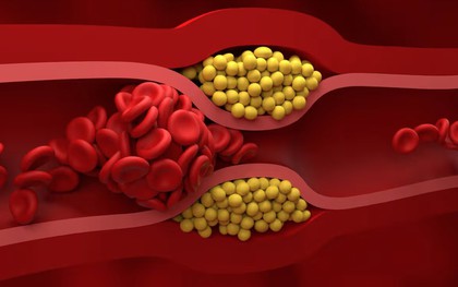 Không cần thực phẩm đắt tiền, bác sĩ chỉ 4 món quen thuộc giúp giảm cholesterol “cực đỉnh”