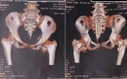 Bé gái 12 tuổi mắc "hội chứng người hóa đá" hiếm gặp, bố mẹ ngỡ ngàng khi bác sĩ nhắc tới cú ngã xe đạp 2 năm trước