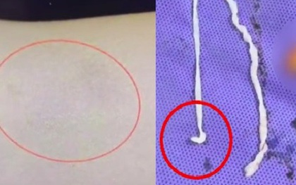 Người phụ nữ đau tay đi khám, bác sĩ kinh ngạc khi thấy thứ bên trong